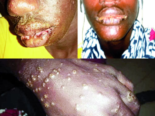 MALADIE MYSTÉRIEUSE CHEZ LES PECHEURS - 210 patients libérés