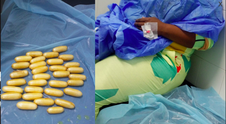 TRAFIC DE DROGUE - Une Sud-africaine interceptée à l'aéroport expulse 92 boulettes de cocaïne