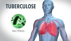TUBERCULOSE- Près de 500 cas enregistrés en six mois à Pikine et Guédiawaye
