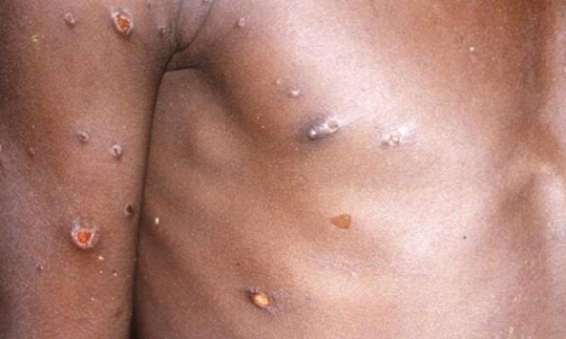 VARIOLE DU SINGE - Le Sénégal enregistre son premier cas