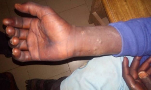 MALADIE MYSTÉRIEUSE- 260 personnes infectées à Thiès