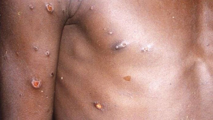PREMIER CAS DE MPOX DÉTECTÉ AU SÉNÉGAL - 25 personnes identifiées comme contacts