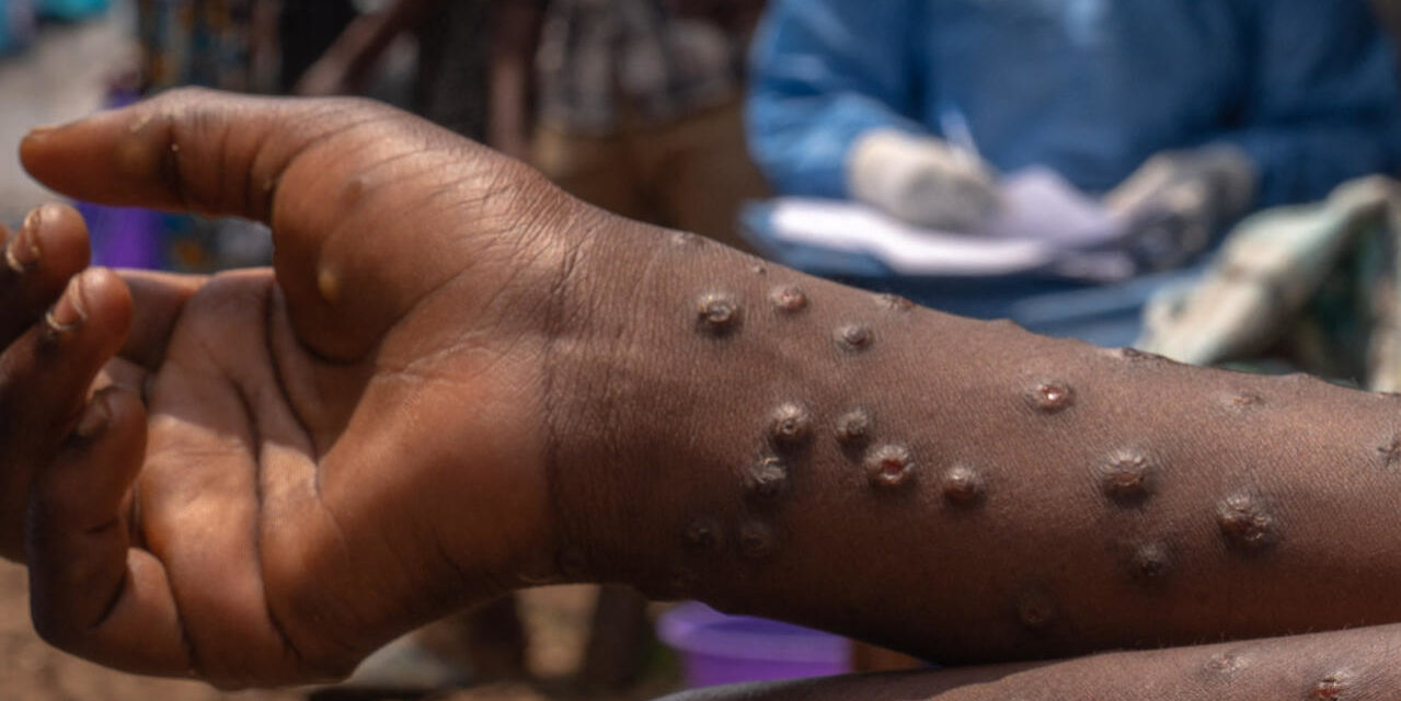 MPOX - Le Sénégal annonce la guérison de "son" cas importé