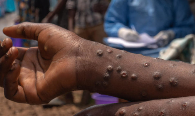 MPOX - Le Sénégal annonce la guérison de "son" cas importé